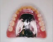 金属床義歯（コバルトクロム合金）