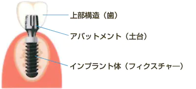 インプラント治療