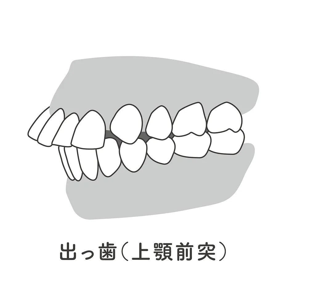 上顎前突・出っ歯