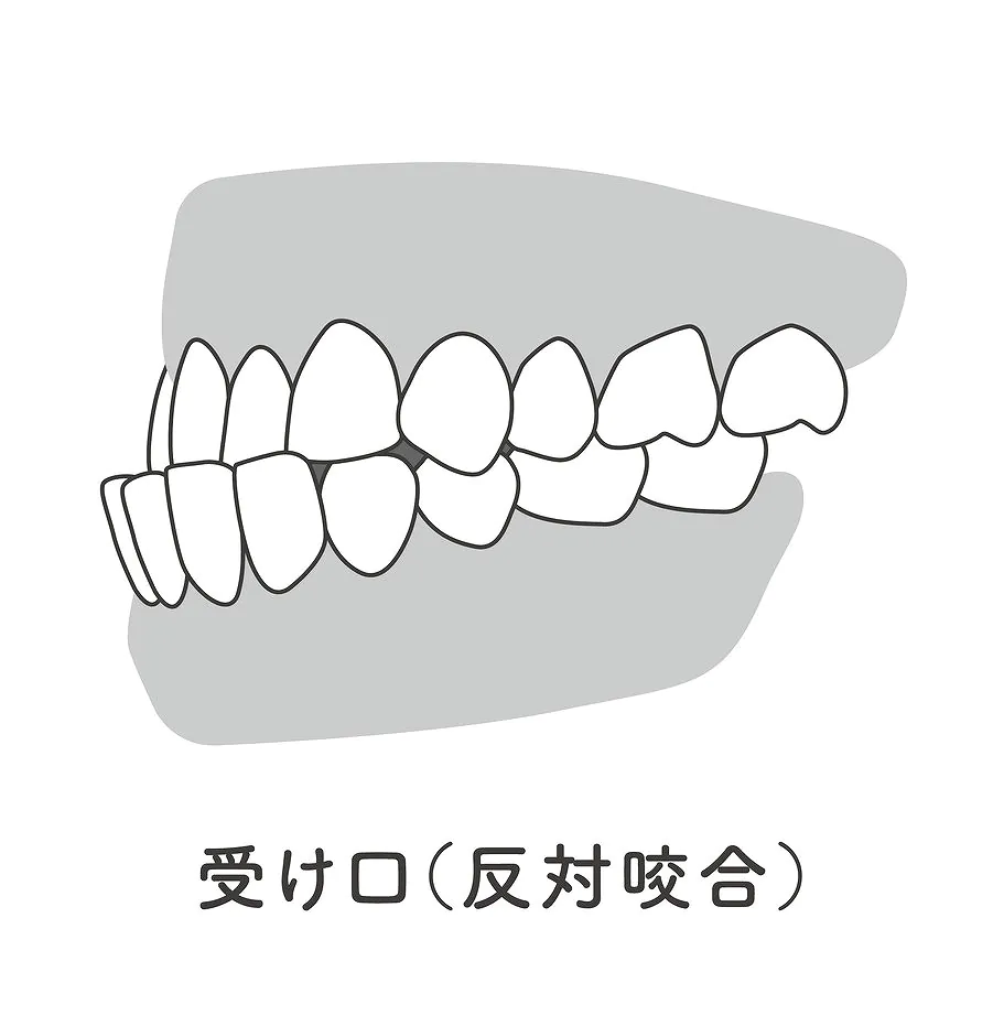 下顎前突・反対咬合・受け口