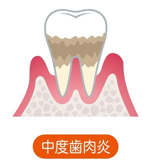 中等度歯周炎