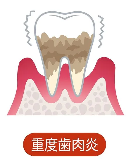 重度歯周炎