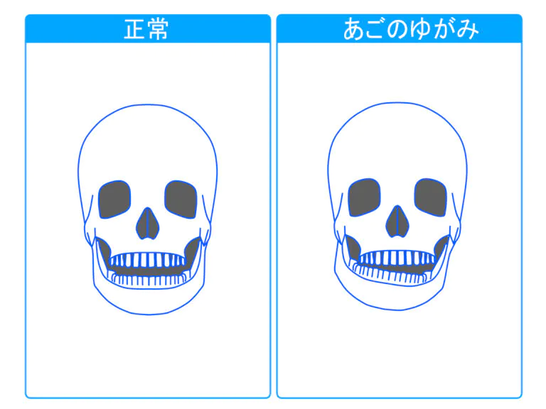 顎関節症